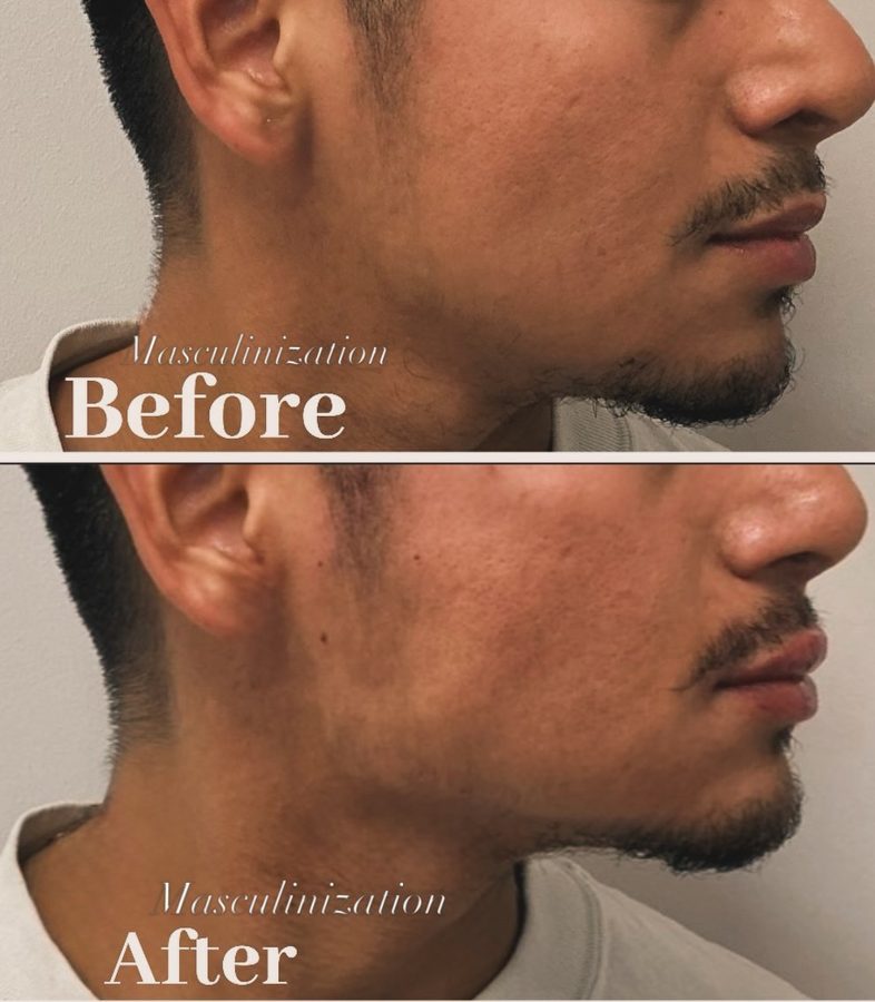 Before and after facial fillers
